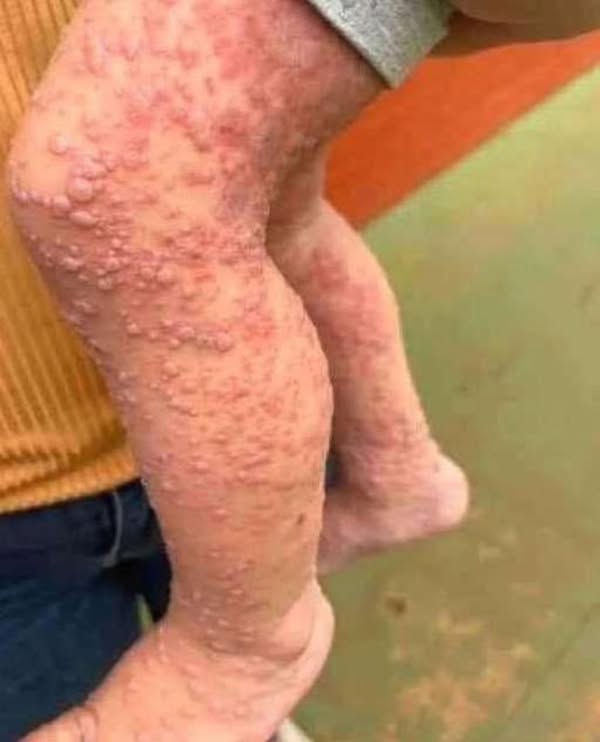 His whole body was itchy, he thought it was an allergy and was diagnosed…See more