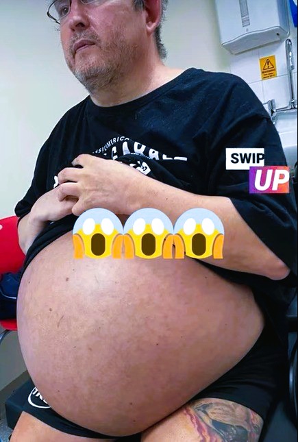 Bloke has ‘record-breaking’ kidneys removed after they start crushing his organs