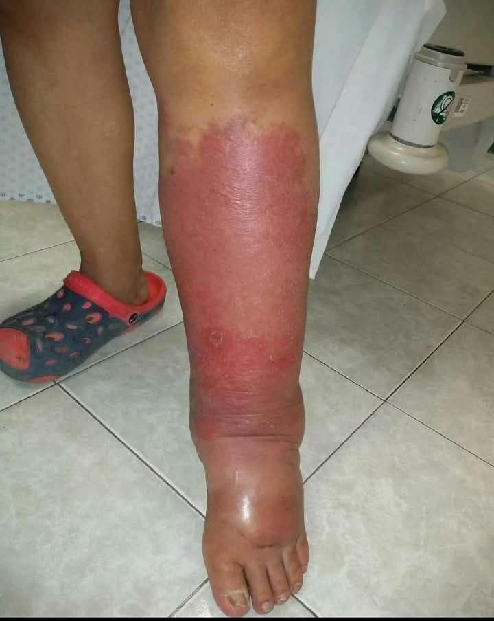 Her foot was swollen for years, finally she goes to the doctor, and he reveals the horrifying reasonSee more