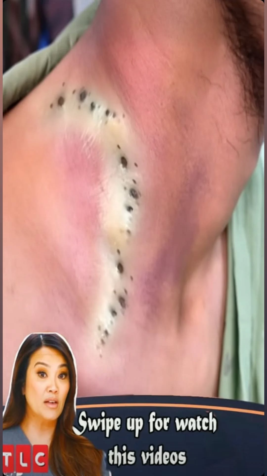 Blackheads – Pimple