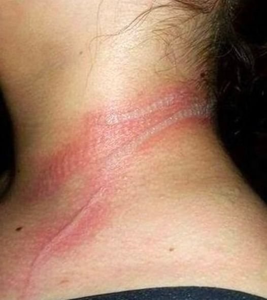 She looked at her little girl and saw devastating wounds on her neck. When she realized what had happened, she was beside herself 😱 Be careful, because it can happen to your child as well 😞 Full story in Comments 👇