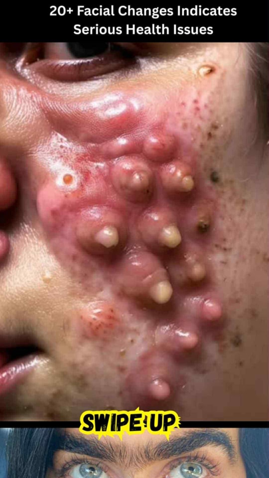 Big Cystic Acne Blackheads Extraction Blackheads & Milia, Whiteheads Removal Pimple Popping