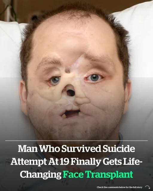 There Was Nothing Left of His Face—One Shot Changed Everything