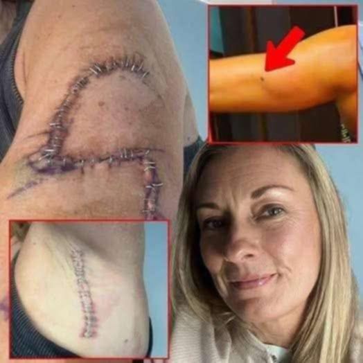 She Thought It Was Just a Mole… 77 Stitches Later, Doctors Told Her the Truth….😱
