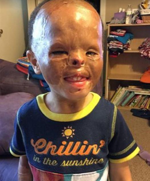 He was just a baby when a fire ripped through the apartment where he slept, leaving him with horrific burns all over his face. Deyvion was an orphan, with no mom or dad to care for him until he was adopted after 2,545 days. Sit down before you see him today, years later 😲👇