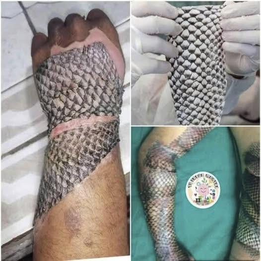 Doctors Are Now Using Tilapia Skin to Heal Severe Burns — And the Results Are Staggering 🔥🐟 (Full story in the first comment ⬇️)