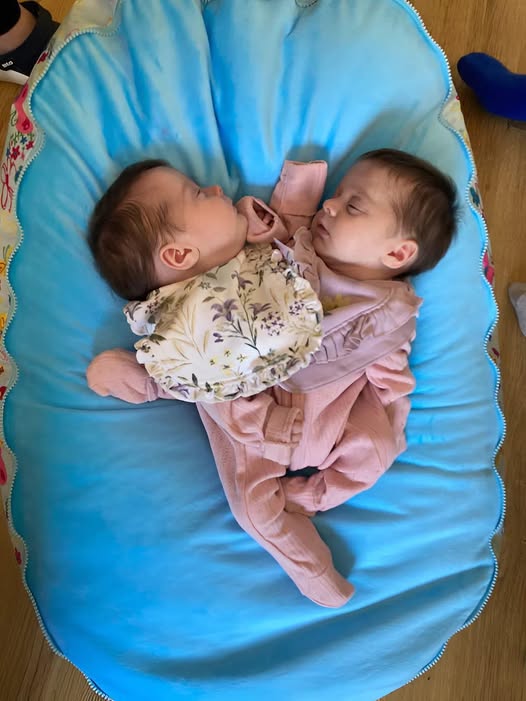 These conjoined twin sisters were born joined at the chest and shared a liver, intestines, and other vital organs 😲. In addition, each sister had only one leg 😱. When they were just 6 months old, doctors decided to separate them. The surgery lasted 18 hours, but the surgeons managed to successfully complete it 😍. Today, the sisters are 3 years old. Curious to see what the twins look like after all these years? Their post-separation photos were shown in the first comment 👇👇