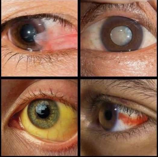 Signs in your EYES that could indicate serious health issues… Your body often speaks through your eyes — are you paying attention? 😳 ➡️ See the full list in the first comment.