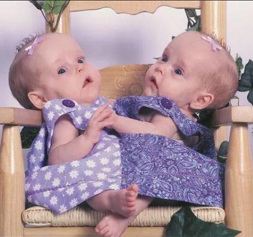 Conjoined twin sisters who were famously ”cut in half” in 2006 and became world pioneers are now living as separate adults. Try not to smile when you see these girls today… Check the comments 🥹🙏🏻