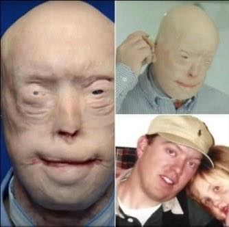 He suffered devastating burns when he tried to rescue a woman trapped in a fire. For years, he was terrified to show his face to the world, and wore caps, sunglasses and prosthetic ears in public. A few years ago, Patrick got the most extensive face transplant ever. I was not ready for how he looks now, and you won’t be either 💔 😳