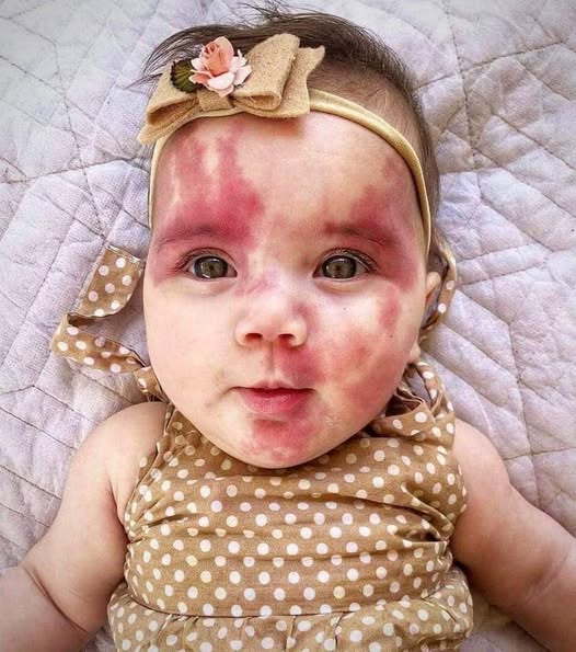 Her face looked grilled’: Baby called ‘hideous’ and ‘defective’ when born, but wait till you see this little princess today…See more(LINK IN FIRST COMMENT 👇)