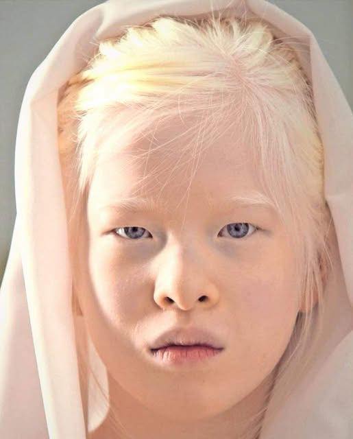 A baby girl born with albinism was abandoned by her parents. They left her at an orphanage door because she looked too “strange” for them. Try not to smile when you see her today: Check in comments 😢