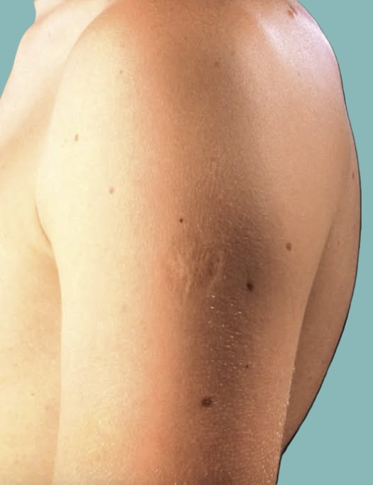 Here’s The Truth Behind This Scar On People’s Upper Left Arm 😮