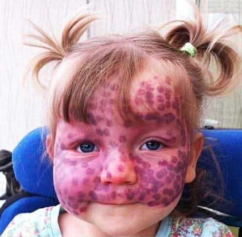 This precious little girl was born covered in polka dots. At first, her parents thought they were just bruises, but when they got to the doctor they found out the truth….. Read full story in comment../////