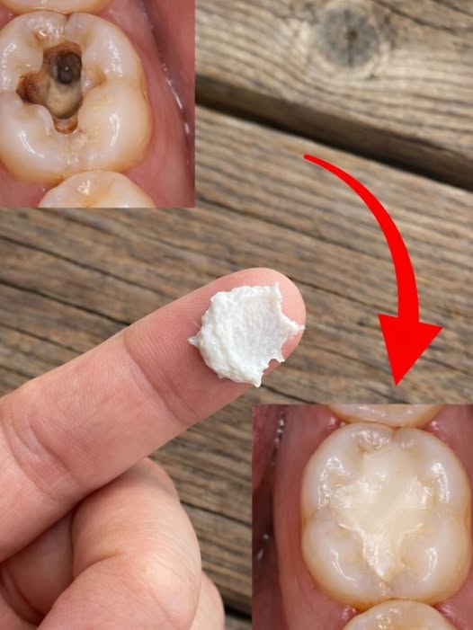 🦷✨ Want to Avoid Painful Dentist Visits? These Simple Tips May Help Support Natural Cavity Repair — Most People Have No Idea… Check the First Comment 👇