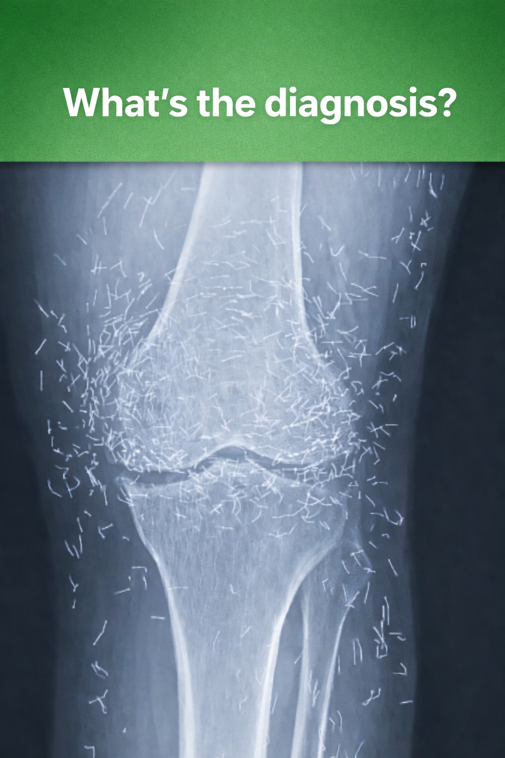 A 65-year-old woman came to the clinic after experiencing months of chronic knee pain. Despite trying multiple treatments including traditional Chinese medicine she found no relief. This X-ray was taken during her visit. What do you think is the diagnosis. 🦴 Answer in the comments 👇🏼